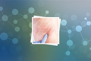 انتشار نتایج مثبت نانوداروی ضد بیماری پوستی