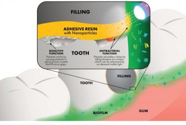 چسب پلیمری نانویی برای کمک به دندان‌پزشکان