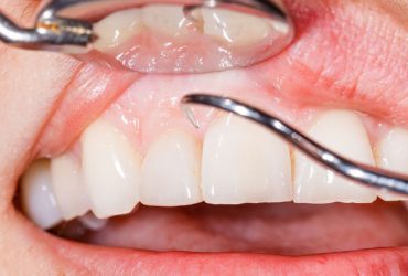 پوشش نانوذره‌ای که مانع پوسیدگی دندان‌ها می‌شود