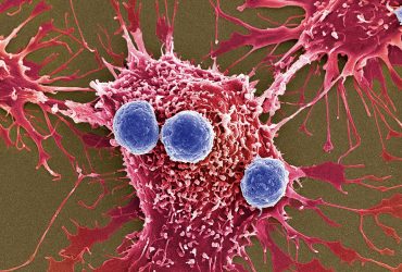 گامی رو به جلو برای ساخت نانوواکسن ضدسرطان شخصی