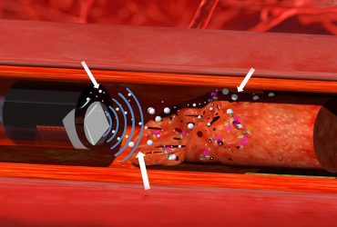لخته‌های خون با کمک فراصوت و نانوقطره حل می‌شوند!