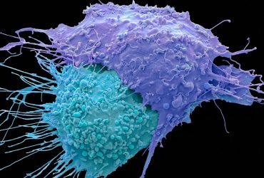 نانوداروی ضدسرطان حاوی فناوری RNA در مسیر تست‌های بالینی