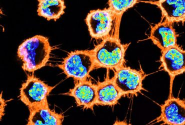 بررسی نقش نانولوله‌های زیستی در بیماری پارکینسون
