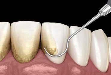 درمان با “نانوزیم” از ایجاد پلاک مضر دندان جلوگیری می‌کند