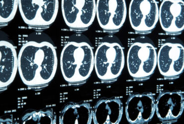 MRI نانویی می‌تواند سرطان را زودهنگام شناسایی کند