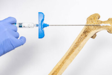 استارت‌آپ سوئیسی ترمیم استخوان را با استفاده از هیدروژل انجام داد