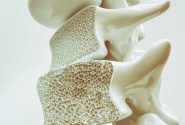 استفاده از فناوری نانو برای درمان پوکی استخوان