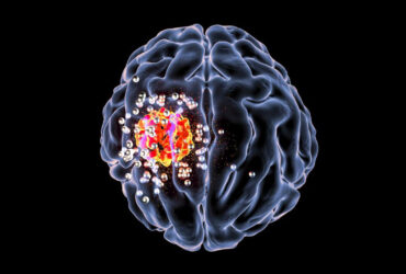نانوذرات چسبنده زیستی برای مبارزه با سرطان مغز به کار گرفته شدند