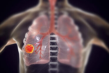 تشخیص زودهنگام سرطان ریه با آزمایش خون امکان‌پذیر خواهد شد