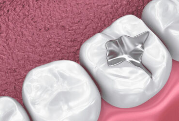 «شیاربند دندان»، محصول دانش‌بنیانی که وارد بازار شده است
