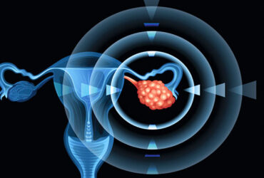 توسعه نانوداروی ضدسرطان تخمدان درترکیه