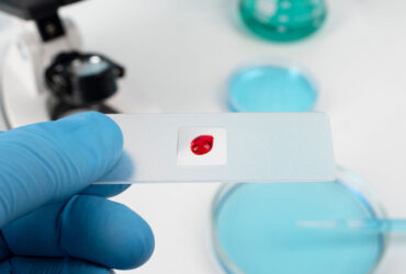 طراحی دستگاه بویایی نوری مینیاتوری برای شناسایی زودهنگام سرطان‌های خونی در بزرگسالان