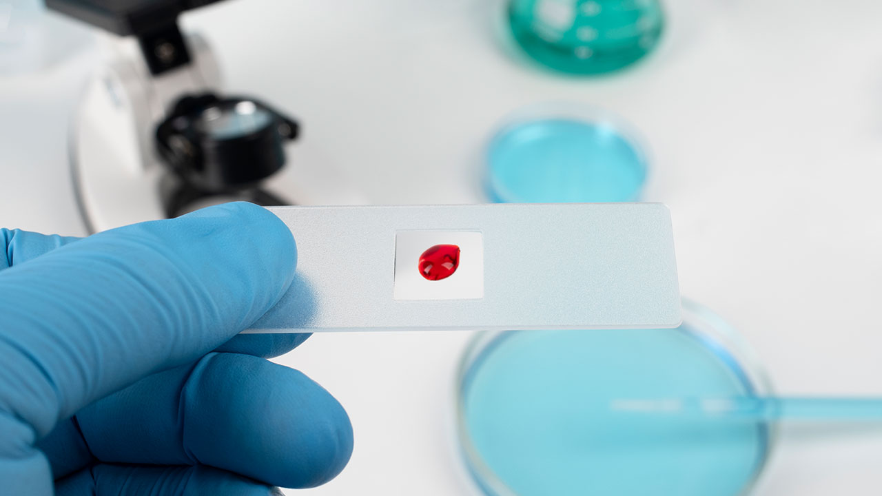 طراحی دستگاه بویایی نوری مینیاتوری برای شناسایی زودهنگام سرطان‌های خونی در بزرگسالان