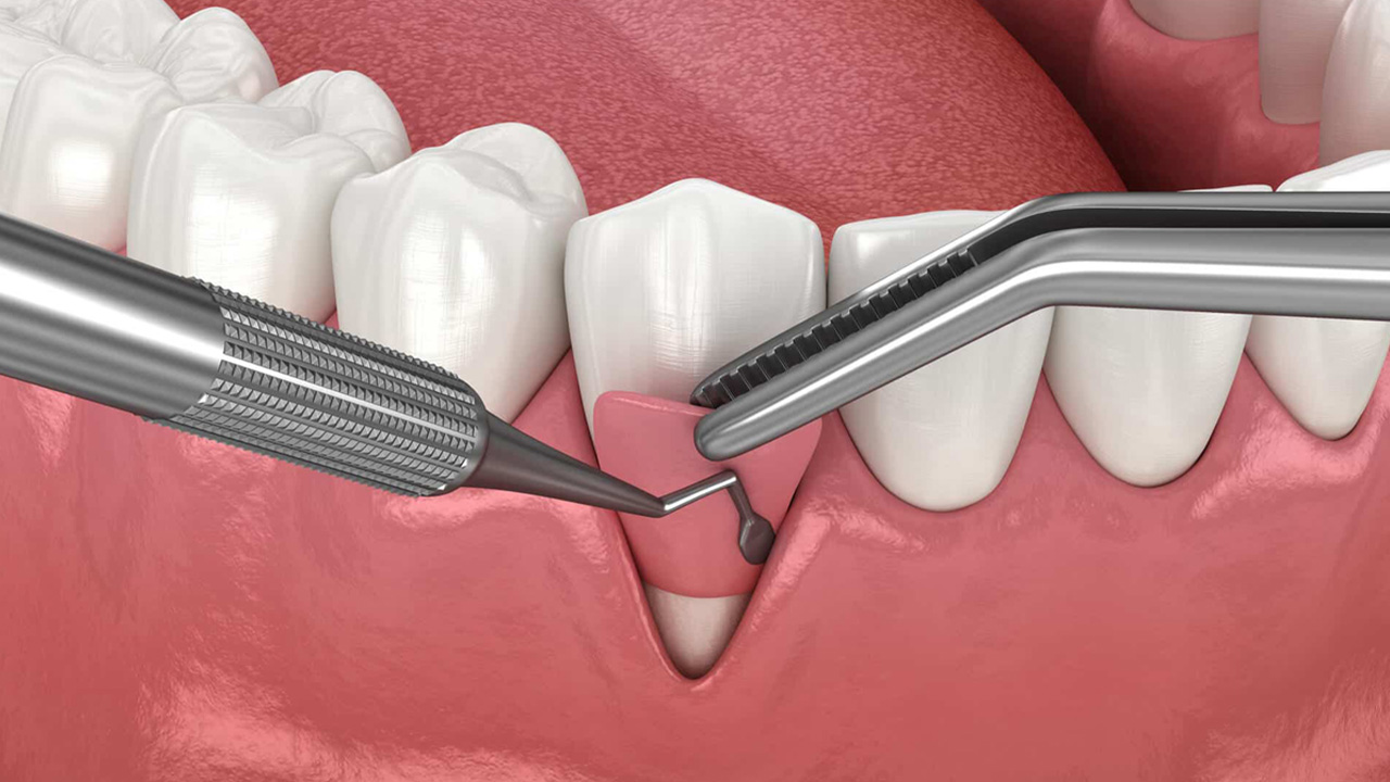 جراحی‌های دندان‌پزشکی با اسفنج نانویی چندمنظوره ساده‌تر می‌شود