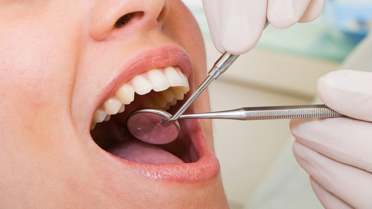 نانوکامپوزیت‌های ایرانی ویژه ترمیم دندان چه مزایایی دارند؟